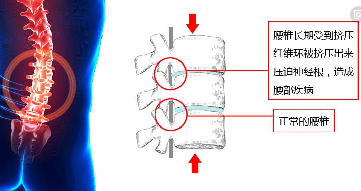 爲什麽正骨可以治好腰椎間盤突出症？淺析腰突的病因與正骨原理