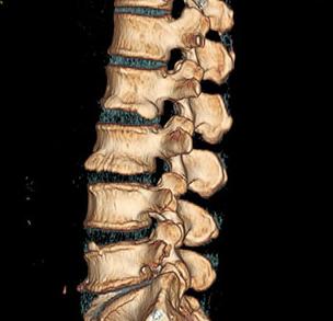 痛立止理骨術：腰椎滑脫病因與症狀分(fēn)析，純手法如何調理滑脫？