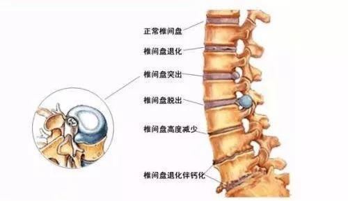 爲什麽越來越多年輕人也有腰椎間盤突出？_腰椎間盤突出症狀