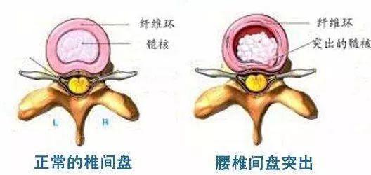 爲什麽越來越多年輕人也有腰椎間盤突出？_腰椎間盤突出症狀